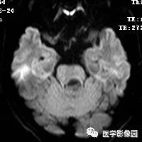 【病例】四脑室毛细胞型星形细胞瘤1例CT及MR 【病例】四脑室毛细胞型星形细胞瘤1例CT及MR