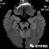 【病例】四脑室毛细胞型星形细胞瘤1例CT及MR 【病例】四脑室毛细胞型星形细胞瘤1例CT及MR