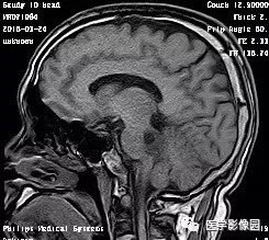 【病例】四脑室毛细胞型星形细胞瘤1例CT及MR 【病例】四脑室毛细胞型星形细胞瘤1例CT及MR