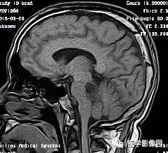 【病例】四脑室毛细胞型星形细胞瘤1例CT及MR 【病例】四脑室毛细胞型星形细胞瘤1例CT及MR