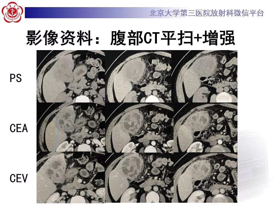 【病例】黄色肉芽肿性胆囊炎1例CT影像表现