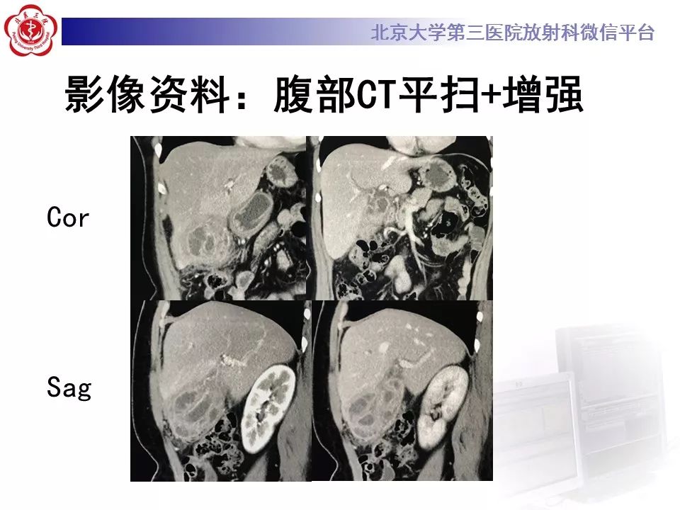 【病例】黄色肉芽肿性胆囊炎1例CT影像表现