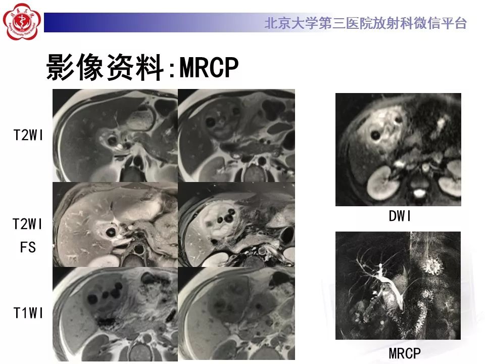 【病例】黄色肉芽肿性胆囊炎1例CT影像表现
