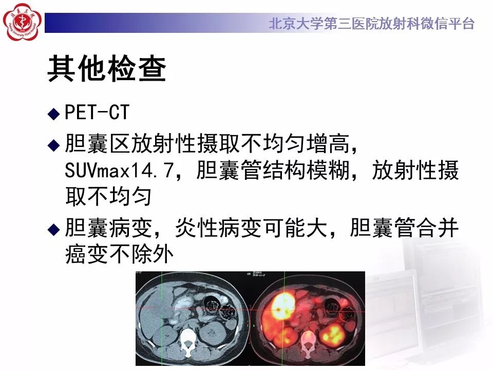 【病例】黄色肉芽肿性胆囊炎1例CT影像表现