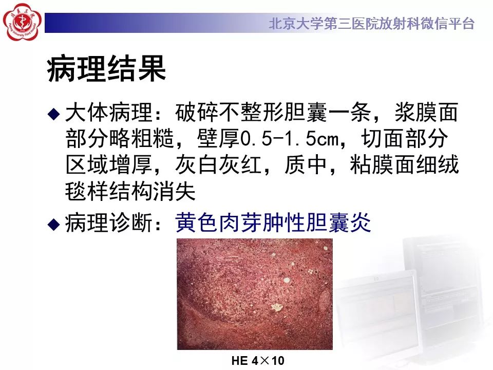 【病例】黄色肉芽肿性胆囊炎1例CT影像表现