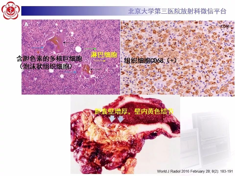 【病例】黄色肉芽肿性胆囊炎1例CT影像表现