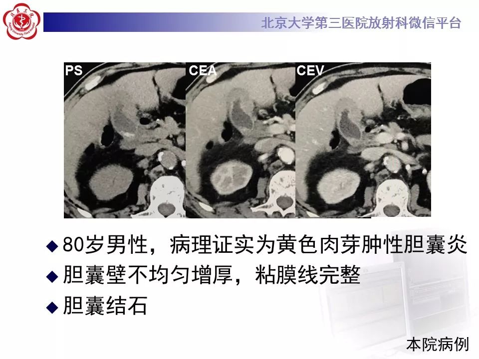 【病例】黄色肉芽肿性胆囊炎1例CT影像表现