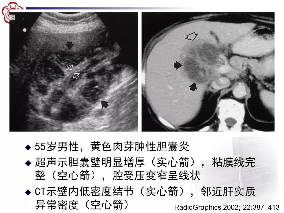 【病例】黄色肉芽肿性胆囊炎1例CT影像表现