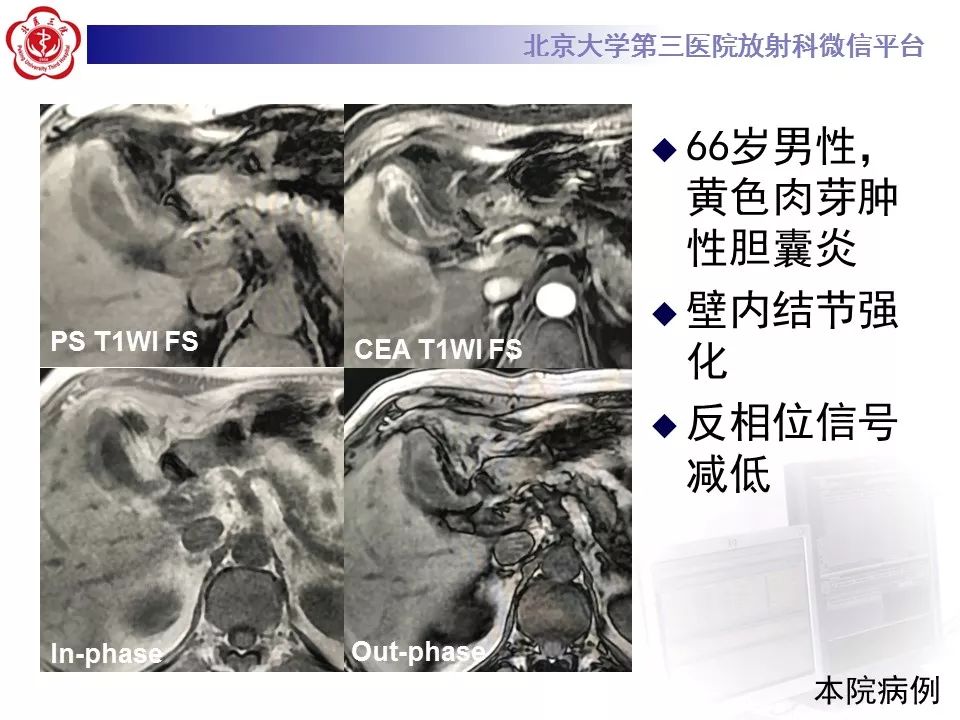 【病例】黄色肉芽肿性胆囊炎1例CT影像表现