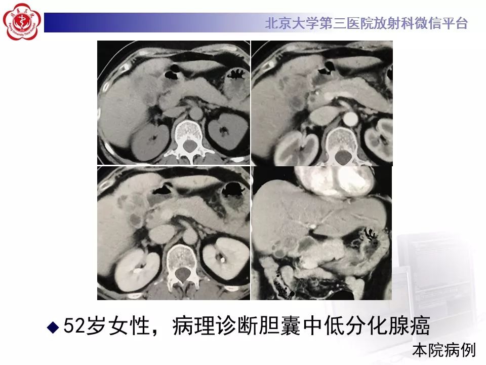 【病例】黄色肉芽肿性胆囊炎1例CT影像表现