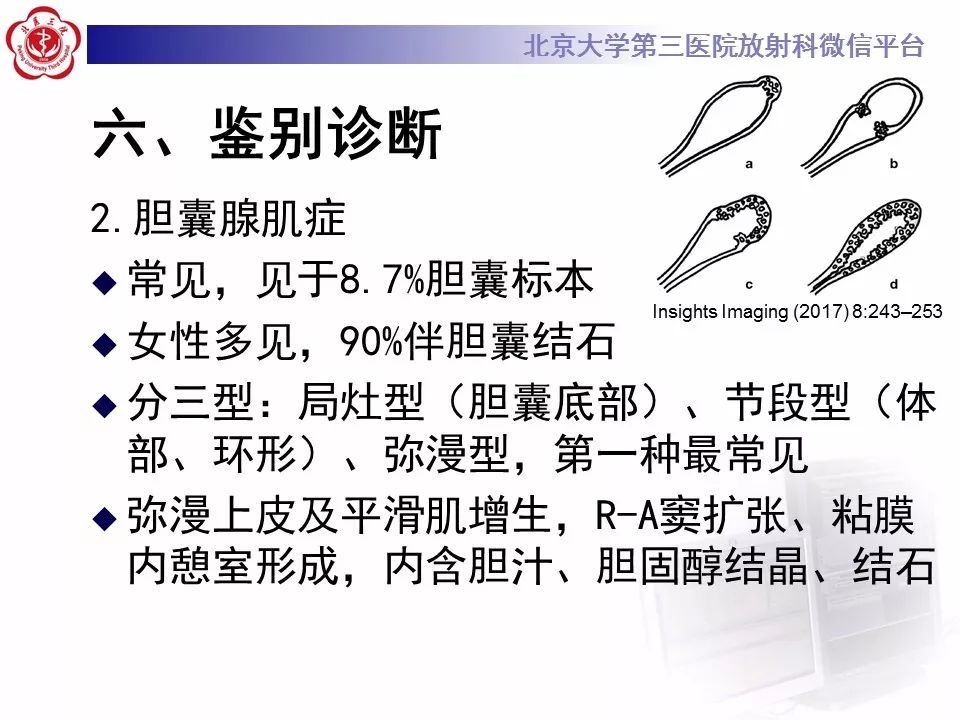 【病例】黄色肉芽肿性胆囊炎1例CT影像表现