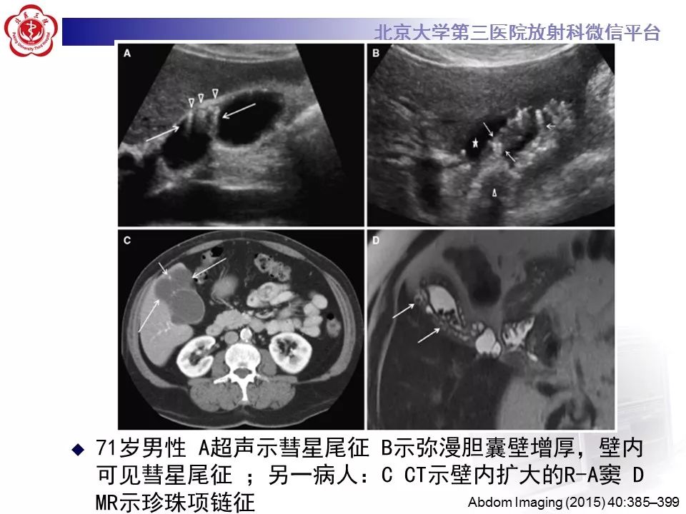 【病例】黄色肉芽肿性胆囊炎1例CT影像表现