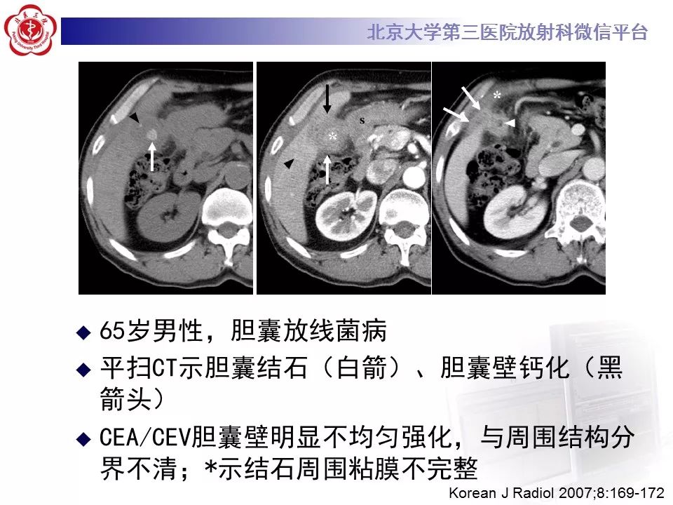 【病例】黄色肉芽肿性胆囊炎1例CT影像表现