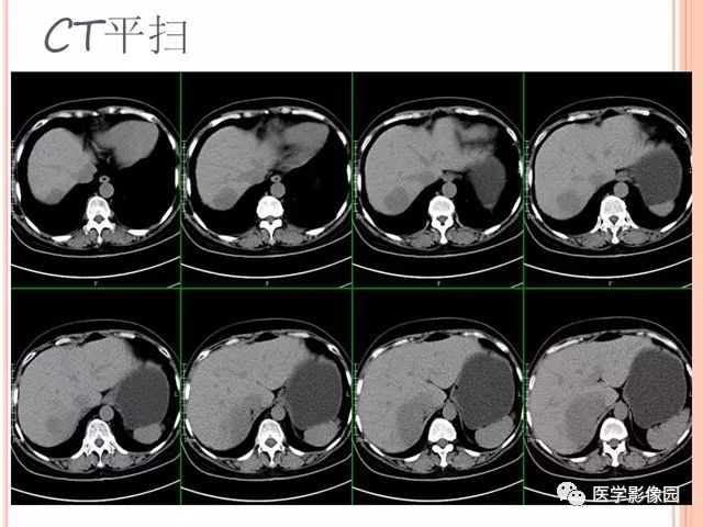 【病例】右肾上腺神经内分泌癌肝转移1例CT 【病例】右肾上腺神经内分泌癌肝转移1例CT