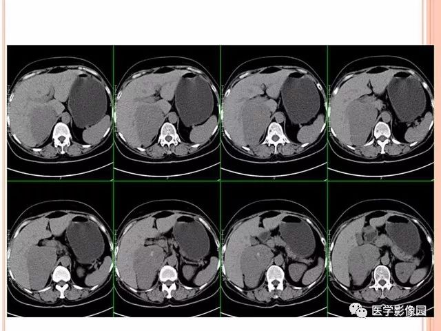 【病例】右肾上腺神经内分泌癌肝转移1例CT 【病例】右肾上腺神经内分泌癌肝转移1例CT