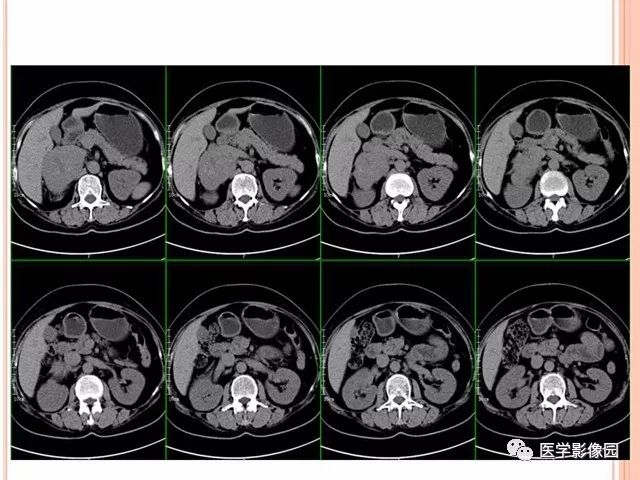 【病例】右肾上腺神经内分泌癌肝转移1例CT 【病例】右肾上腺神经内分泌癌肝转移1例CT