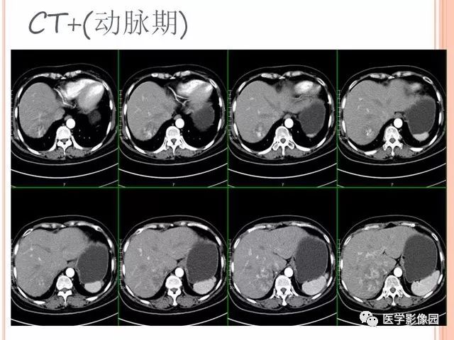 【病例】右肾上腺神经内分泌癌肝转移1例CT 【病例】右肾上腺神经内分泌癌肝转移1例CT