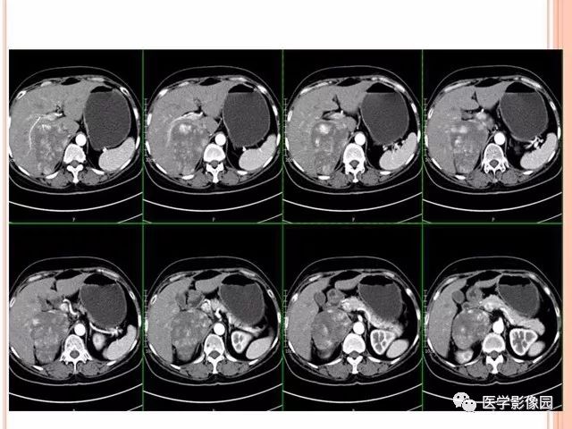 【病例】右肾上腺神经内分泌癌肝转移1例CT 【病例】右肾上腺神经内分泌癌肝转移1例CT