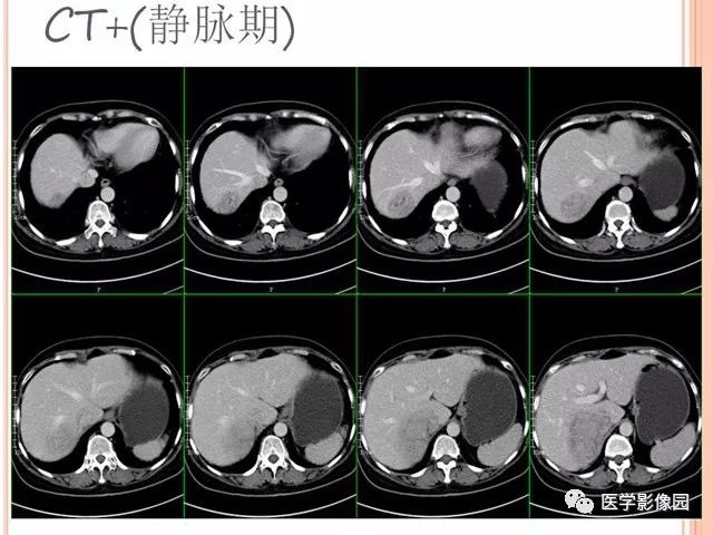 【病例】右肾上腺神经内分泌癌肝转移1例CT 【病例】右肾上腺神经内分泌癌肝转移1例CT