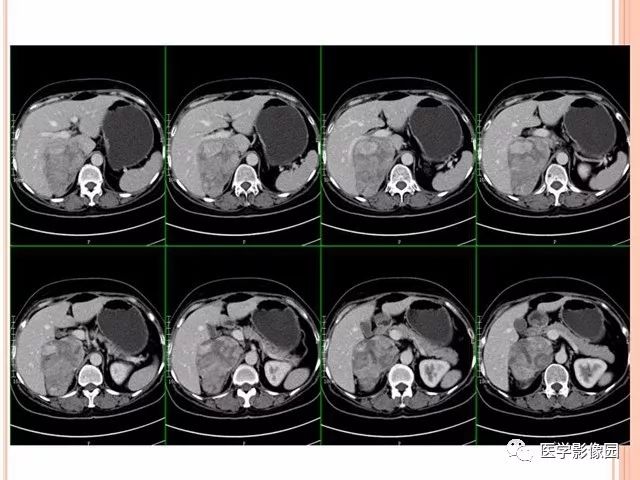 【病例】右肾上腺神经内分泌癌肝转移1例CT 【病例】右肾上腺神经内分泌癌肝转移1例CT