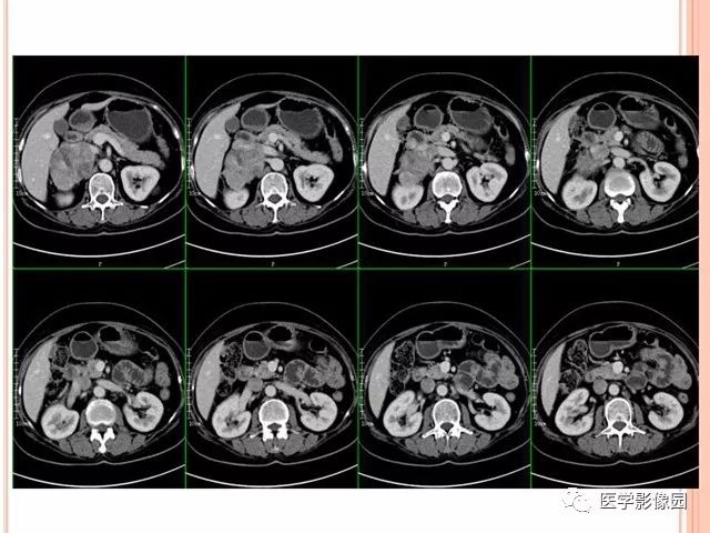 【病例】右肾上腺神经内分泌癌肝转移1例CT 【病例】右肾上腺神经内分泌癌肝转移1例CT