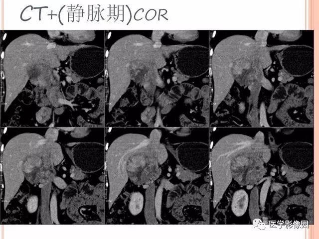 【病例】右肾上腺神经内分泌癌肝转移1例CT 【病例】右肾上腺神经内分泌癌肝转移1例CT