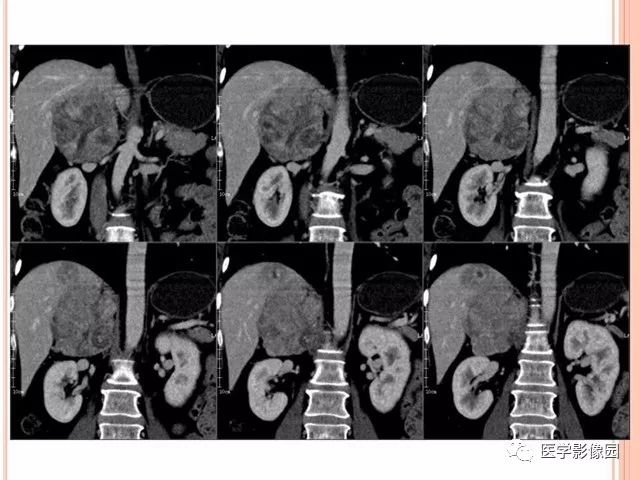 【病例】右肾上腺神经内分泌癌肝转移1例CT 【病例】右肾上腺神经内分泌癌肝转移1例CT