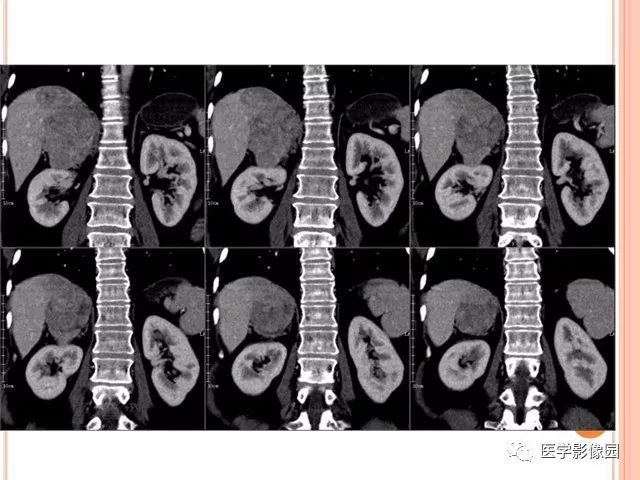 【病例】右肾上腺神经内分泌癌肝转移1例CT 【病例】右肾上腺神经内分泌癌肝转移1例CT