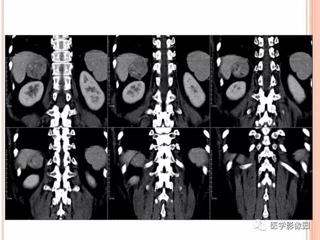 【病例】右肾上腺神经内分泌癌肝转移1例CT 【病例】右肾上腺神经内分泌癌肝转移1例CT