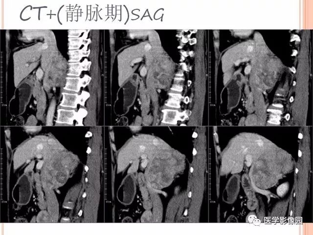 【病例】右肾上腺神经内分泌癌肝转移1例CT 【病例】右肾上腺神经内分泌癌肝转移1例CT