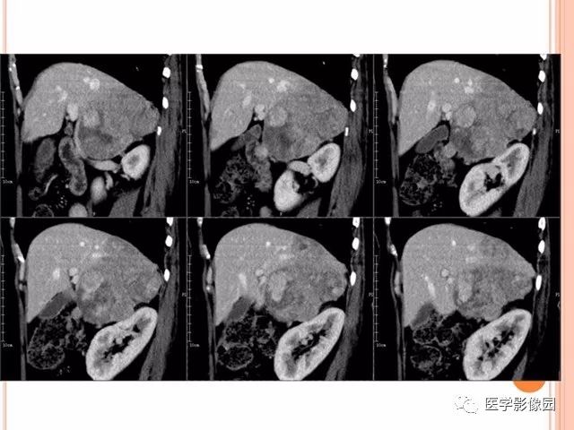 【病例】右肾上腺神经内分泌癌肝转移1例CT 【病例】右肾上腺神经内分泌癌肝转移1例CT