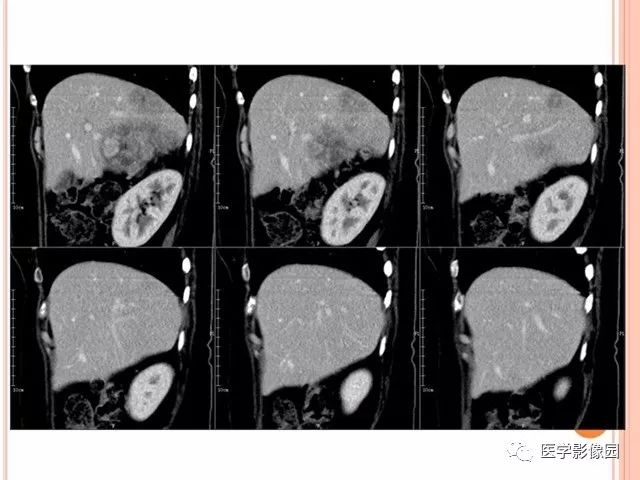 【病例】右肾上腺神经内分泌癌肝转移1例CT 【病例】右肾上腺神经内分泌癌肝转移1例CT