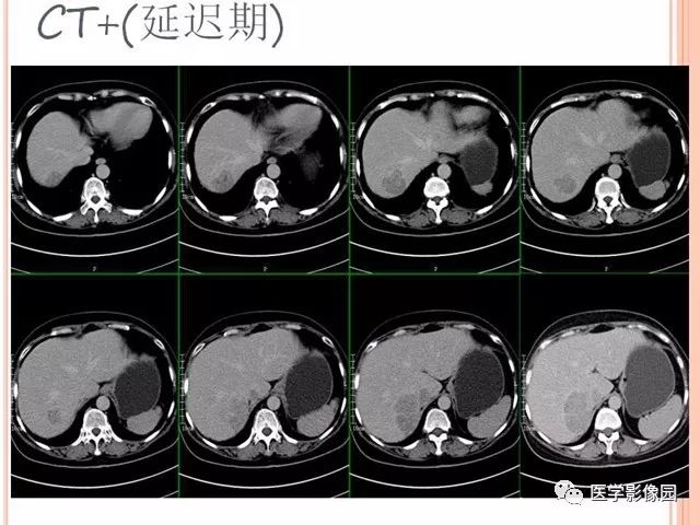 【病例】右肾上腺神经内分泌癌肝转移1例CT 【病例】右肾上腺神经内分泌癌肝转移1例CT