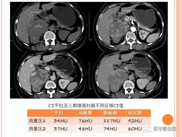 【病例】右肾上腺神经内分泌癌肝转移1例CT 【病例】右肾上腺神经内分泌癌肝转移1例CT