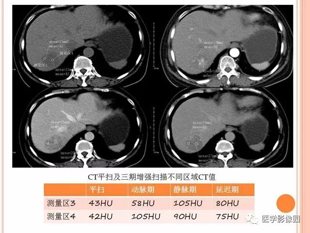 【病例】右肾上腺神经内分泌癌肝转移1例CT 【病例】右肾上腺神经内分泌癌肝转移1例CT