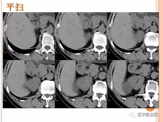 【病例】右肾囊性肾癌1例CT影像表现 【病例】右肾囊性肾癌1例CT影像表现