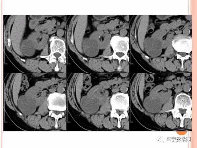 【病例】右肾囊性肾癌1例CT影像表现 【病例】右肾囊性肾癌1例CT影像表现