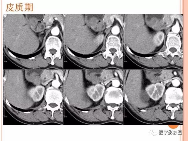 【病例】右肾囊性肾癌1例CT影像表现 【病例】右肾囊性肾癌1例CT影像表现