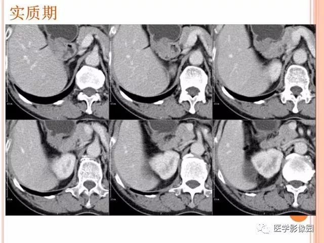 【病例】右肾囊性肾癌1例CT影像表现 【病例】右肾囊性肾癌1例CT影像表现