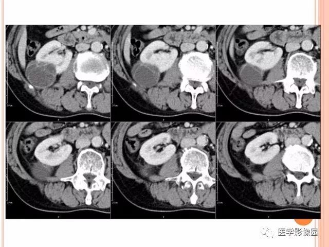 【病例】右肾囊性肾癌1例CT影像表现 【病例】右肾囊性肾癌1例CT影像表现
