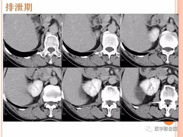 【病例】右肾囊性肾癌1例CT影像表现 【病例】右肾囊性肾癌1例CT影像表现