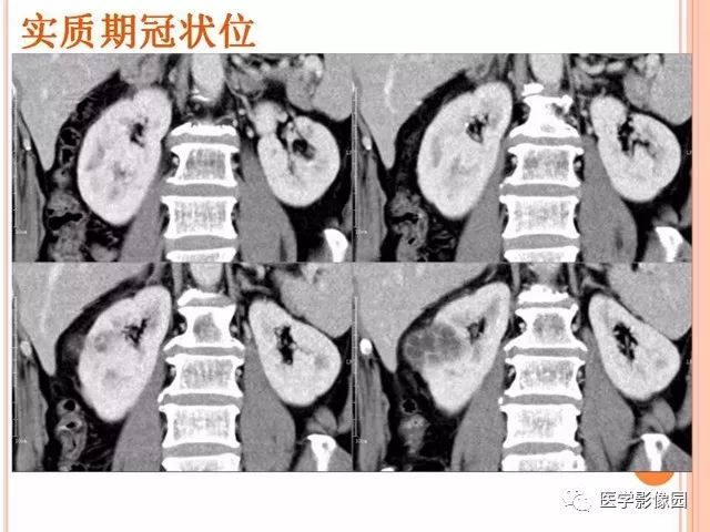 【病例】右肾囊性肾癌1例CT影像表现 【病例】右肾囊性肾癌1例CT影像表现