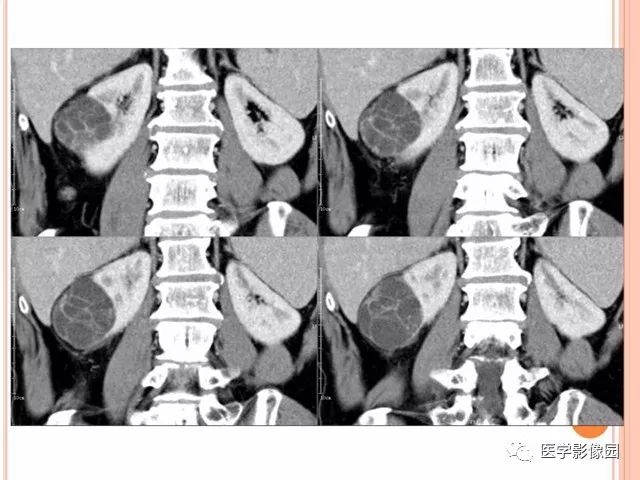 【病例】右肾囊性肾癌1例CT影像表现 【病例】右肾囊性肾癌1例CT影像表现