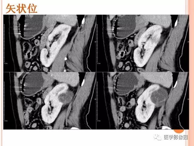 【病例】右肾囊性肾癌1例CT影像表现 【病例】右肾囊性肾癌1例CT影像表现