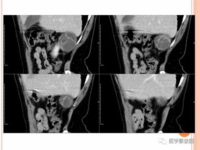 【病例】右肾囊性肾癌1例CT影像表现 【病例】右肾囊性肾癌1例CT影像表现