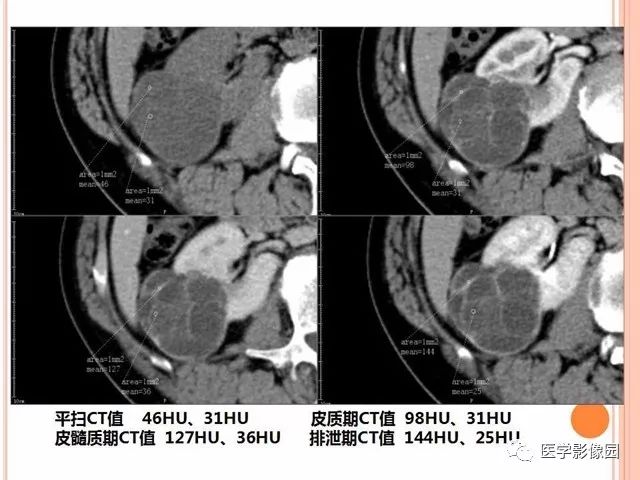 【病例】右肾囊性肾癌1例CT影像表现 【病例】右肾囊性肾癌1例CT影像表现
