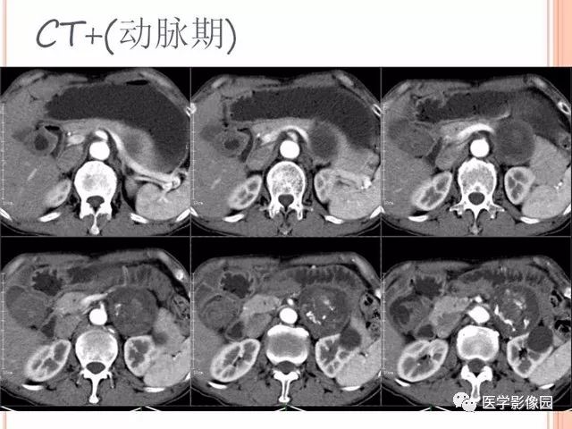 【病例】腹膜后神经鞘瘤囊变钙化1例CT及MR