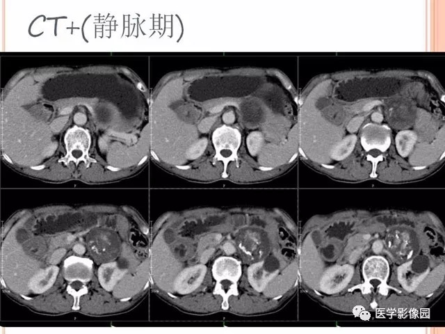 【病例】腹膜后神经鞘瘤囊变钙化1例CT及MR