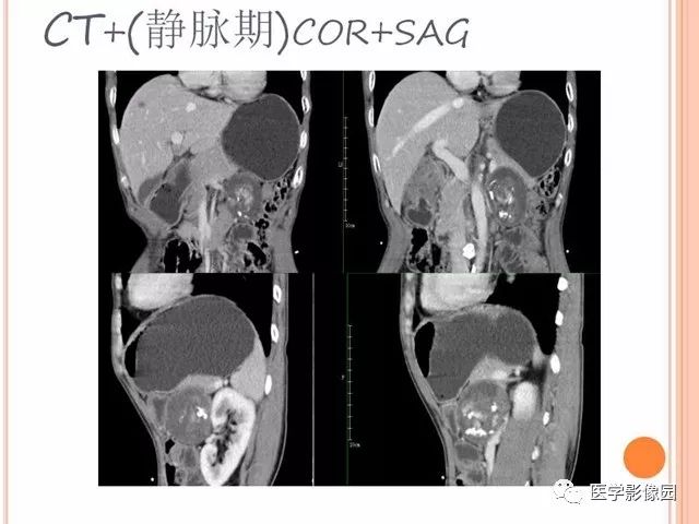 【病例】腹膜后神经鞘瘤囊变钙化1例CT及MR