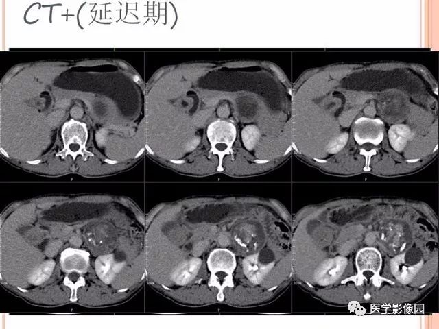 【病例】腹膜后神经鞘瘤囊变钙化1例CT及MR